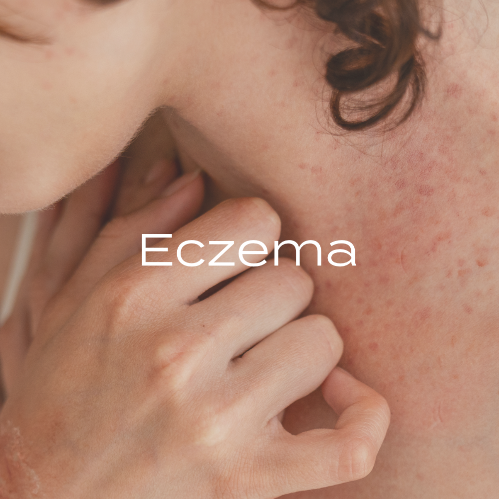 Eczema