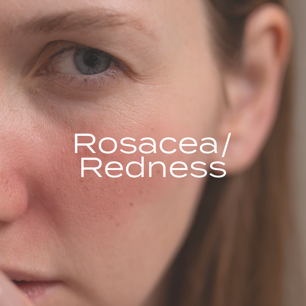 Rosacea / Redness