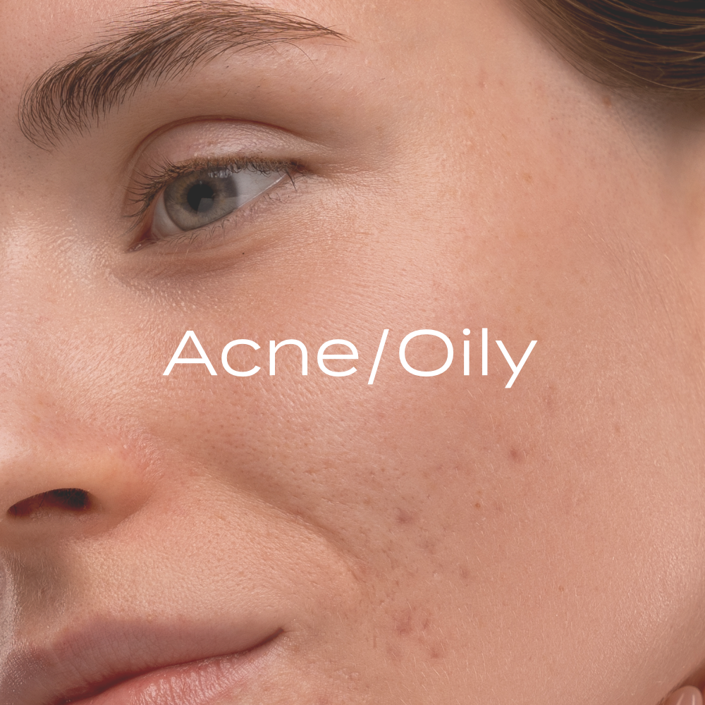Acne / Oily